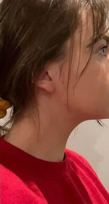 After - 89% Reducción de papada y mejillas hinchadas