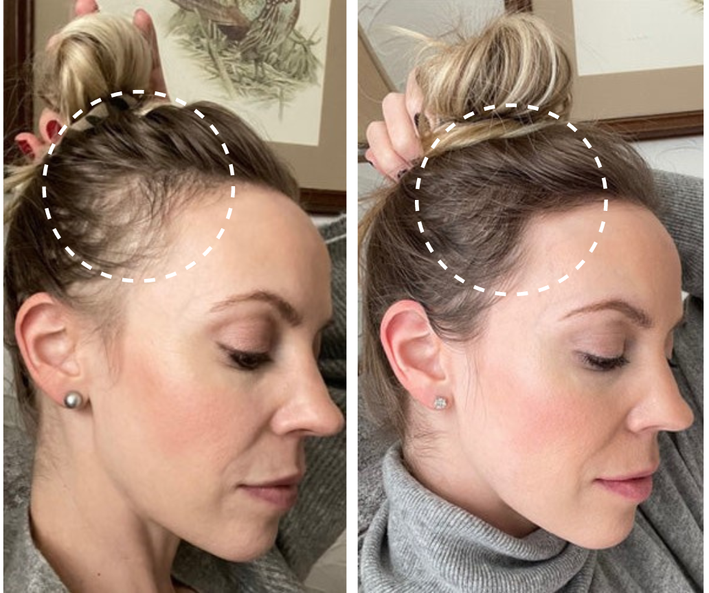 Masajeador capilar Lumine 4 en 1 con terapia de luz roja para el crecimiento del cabello y la salud del cuero cabelludo.