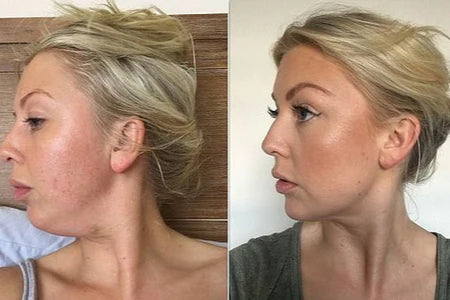 ¿Qué es el problema de la papada?