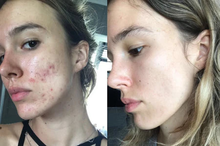 ¿Por qué aparece el acné?