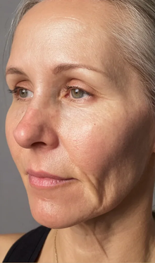 Before - 97% Reducción de líneas finas y arrugas