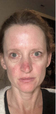 Before - 95% Reducción del acné y la decoloración