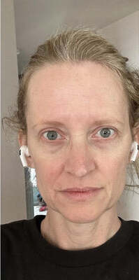 After - 95% Reducción del acné y la decoloración